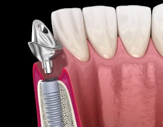 Man and woman with dental implants eating a meal