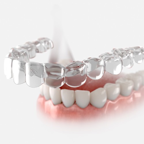 Illustration of clear aligner being placed on teeth