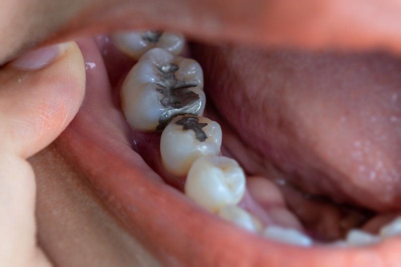 Closeup of metal fillings